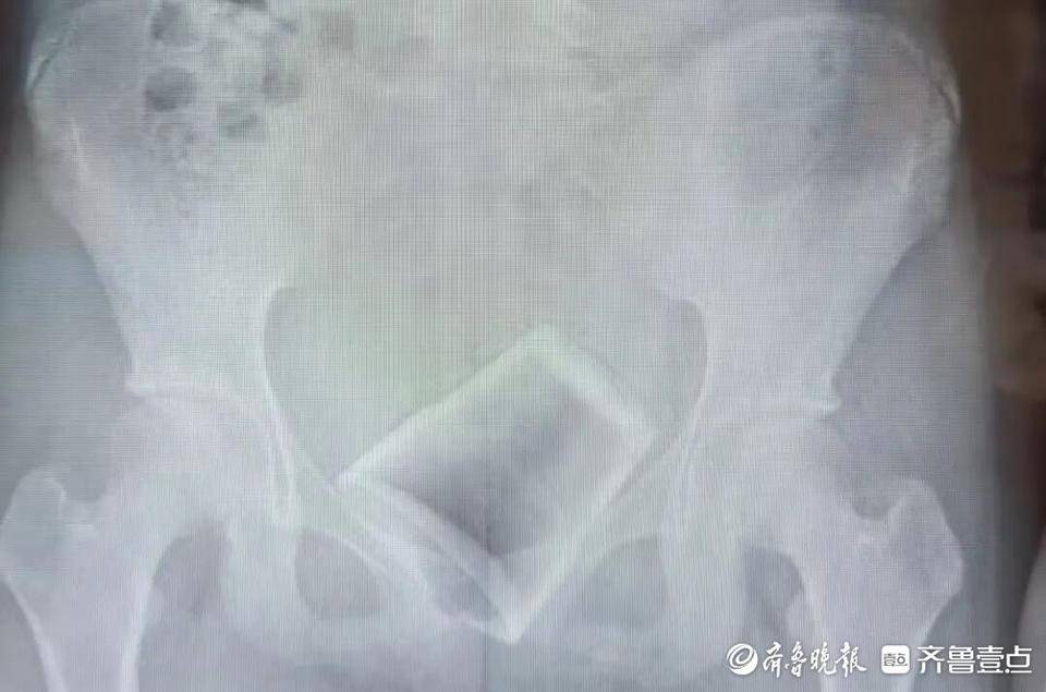 12岁男孩下体插着电线就诊！医生：这些尿道异物要注意
