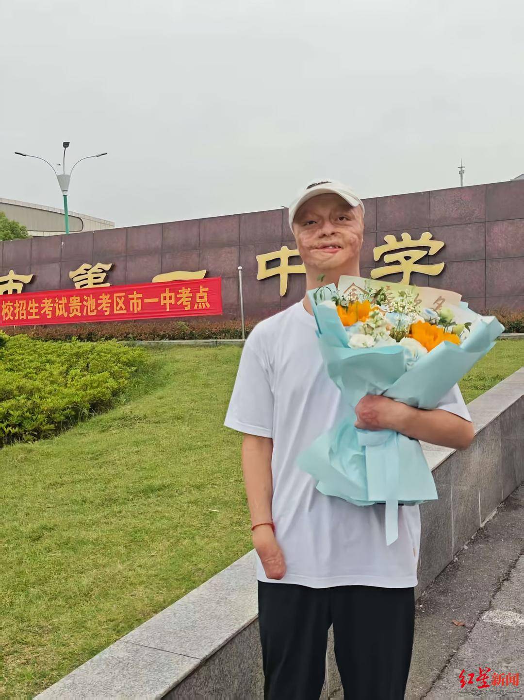“烧伤男孩”高考664分被东南大学录取：曾经历23次手术，计划未来读研读博